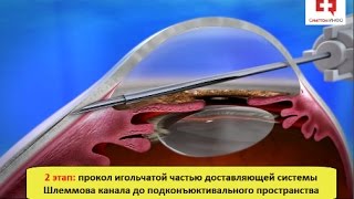 Глаукома лечение: операция подконъюктивального стентирования с использованием XEN Gel stent