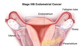 ENDOMETRIAL CANCER OR UTERINE CANCER  OR GARBHASHAY KA CANCER DETAILS KNOWLEDGE ( IN HINDI)