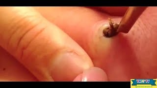 Выдавливание чёрных точек НОВОЕ! Удаление чёрных точек за ухом. p6