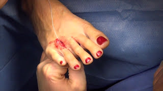 Crooked or "splayed" toe surgery - Arthrex plantar plate repair system - Dr Moore