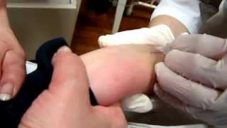 Катетеризация периферических вен у детей