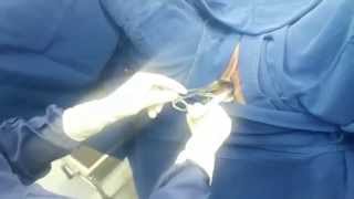 Dispositivo intrauterino (diu) / Intrauterine device (IUD)