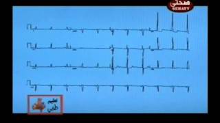 ecg lvh