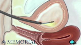 Cystoscopy Female Surgery
