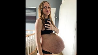 Mom's Baby Bump Won't Stop Growing  Then Doctor's Tell Her The Horrifying Truth