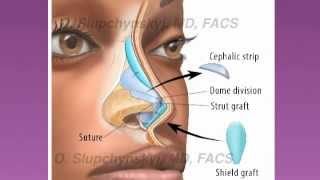 Ethnic Rhinoplasty