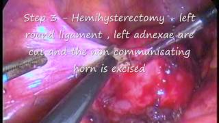non communicating uterine horn, excision, hemihysterectomy, dr c v hegde, mumbai , india