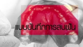 ครอบฟัน ใส่ครอบฟัน พิมพ์ฟัน by หมอบอล