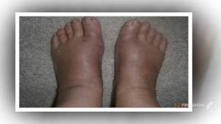 выпрямитель большого пальца ноги

  - Valgus pro купить