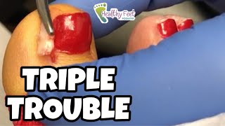 PEDICURES GONE WRONG!  A CURE FOR INGROWN TOENAILS!