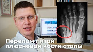 Как лечить перелом плюсневой кости стопы?