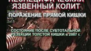 Неспецифический язвенный колит прямой кишки.