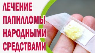 Лечение папилломы народными средствами
