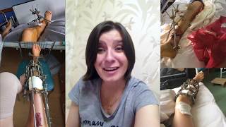Аппарат Илизарова.  Перелом. Ответы на основные вопросы по уходу за ним