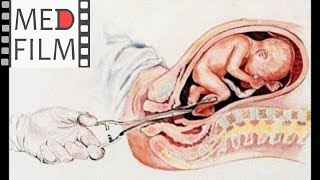 Слабая родовая деятельность, акушерские щипцы, Пентран © Оbstetrician forceps, Pentaran