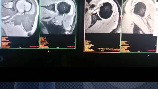 RESONANCIA MAGNETICA EVALUACION DE HOMBRO, Bursitis cronica y lesion labral