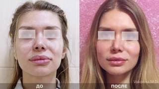 Хейлопластика до и после  у доктора Вакориной ЕИ. Удаление силикона из губ