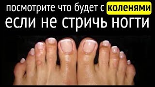 Что будет с коленями, ЕСЛИ НЕ СТРИЧЬ НОГТИ на ногах?