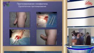 Сокольщик М М - Современные возможности реконструктивной хирургии урогенитальной области