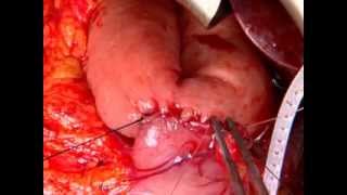 PDR whipple procedure Панкреатодуоденальная резекция ПДР