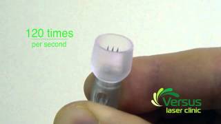 Dermastamp (Vital collagen induction therapy) demonstration