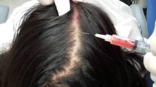 Dr.Thomas Barnes' PRP Hair Growth and Skin Rejuvenation