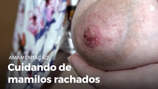 Cuidando de mamilos rachados | Amamentação