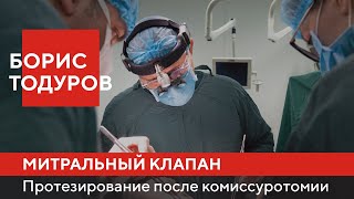 Борис Тодуров | Протезирование митрального клапана после комиссуротомии | Институт сердца