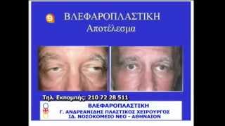 ΒΛΕΦΑΡΟΠΛΑΣΤΙΚΗ, ΠΛΑΣΤΙΚΗ ΣΤΑ ΜΑΤΙΑ, Πλαστική Βλεφάρων