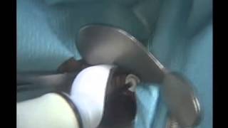 Maut60 from Peters Surgical - Introduction and Screwing