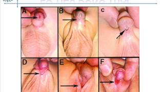 BS NAM KHOA  -  DỊ TẬT CƠ QUAN SINH DỤC NAM