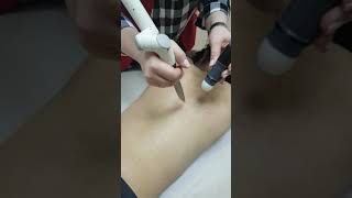 Лечение акне и постакне лазером Фотона на спине. #_top_laser_ #fotonalaser