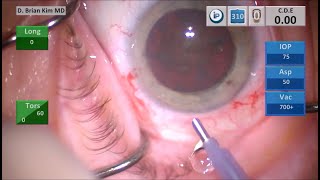 Phaco Sleeve Extension: Mechanical Fracturing the Catarock with Double and Cross Chop