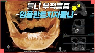 [대전치과, 대전임플란트]틀니 부적응증 - 임플란트지지틀니 ⭐