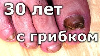 ВЫЛЕЧИЛ грибок ногтей спустя 30 лет / Лечение грибка ногтей на ногах