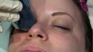Does Thermage Skin Tightening Laser Treatment hurt?