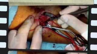 Arteriovenous fistula surgery (AVF)