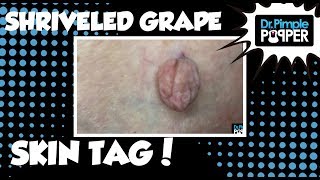 A Shriveled Grape Skin Tag on Inner Thigh