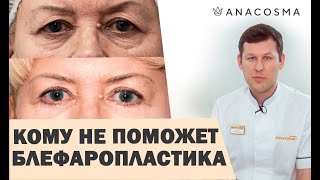 ❗️Блефаропластика: КОМУ НЕ ПОМОЖЕТ? ❗️❗️Нависшее веко как убрать ❗️БЕЗ ОПЕРАЦИИ❗️