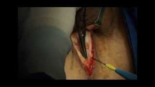 ARGUS T Surgery