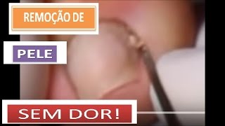 Remoção de pele da lateral da unha
