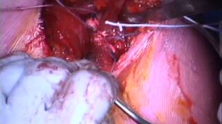 Pec Reattachment Surgery