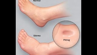 Paki-Check Kung Manas ang Iyong Paa (Check for Edema) - by Doc Willie Ong #326
