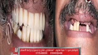 احدث تقنيات زراعة الاسنان و افضل طريقة مع د. مينا هارون