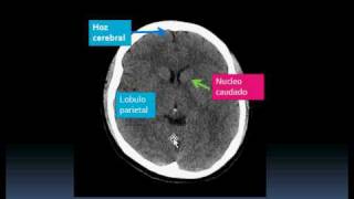 UABC Medicina Interpretacion TAC craneo