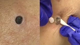 Most Popular DPOWs, Cysts and Blackheads Ever