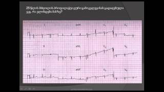 დექსტროკარდია /deqstrokardia / გულის მანკი / ელექტროკარდიოგრამის ანალიზი / გულის თანდაყოლილი მანკები