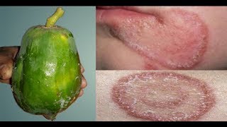 அரிப்பு மற்றும் நமைச்சலை சரி செய்ய இதை செய்யுங்கள்  | Fungal Infection Treatment at Home