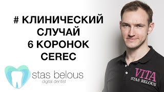 #Стоматолог Стас Белоус #ЛЕЧЕНИЕ зубов по технологии #CEREC #церек Full anatomy anterior crowns emax