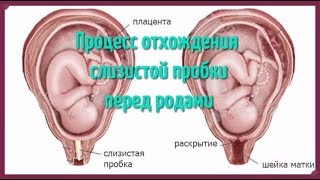 Процесс отхождения слизистой пробки перед родами!
